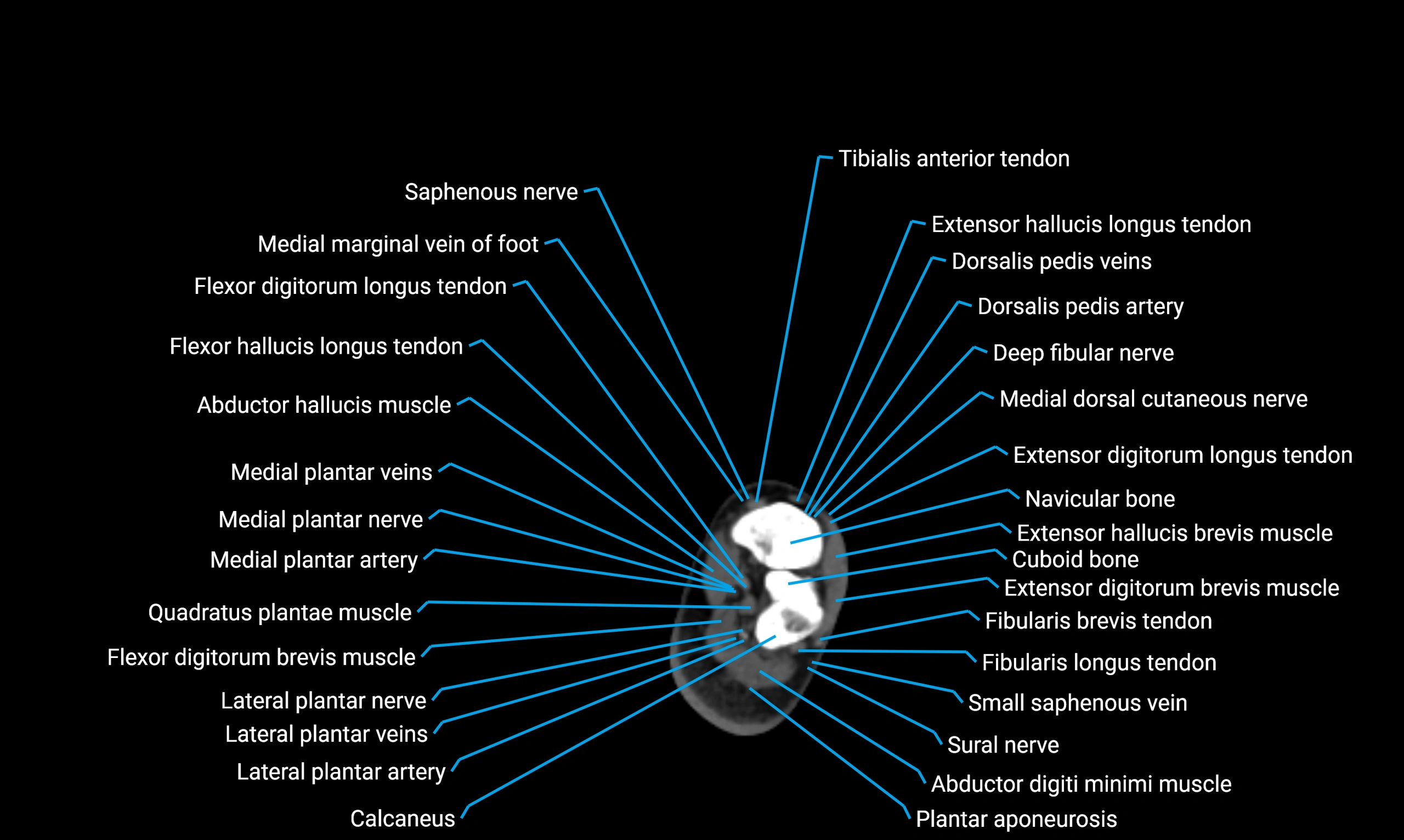 CT lower limb axial cross sectional anatomy labelled image 176 (2).webp